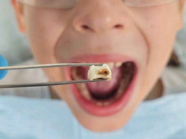 Best Emergency Gum Treatment in Buttonwillow, CA